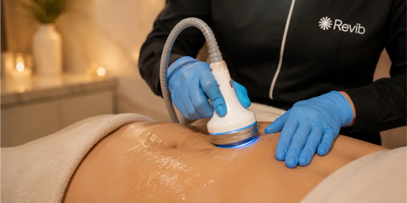 Aplicación de radiofrecuencia corporal en el abdomen