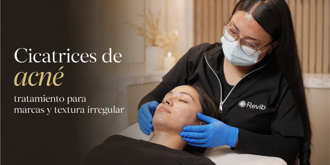 Cicatrices de acné: tratamiento para marcas y textura irregular